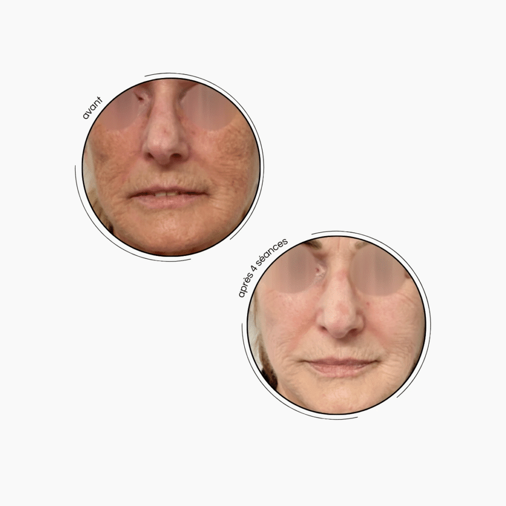 Deuxième avant après avec un traitement avec l'alpha de photoraj'