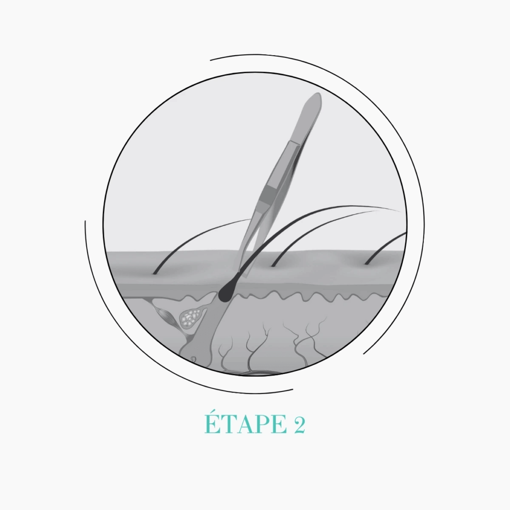 électrolyse épilation électrique