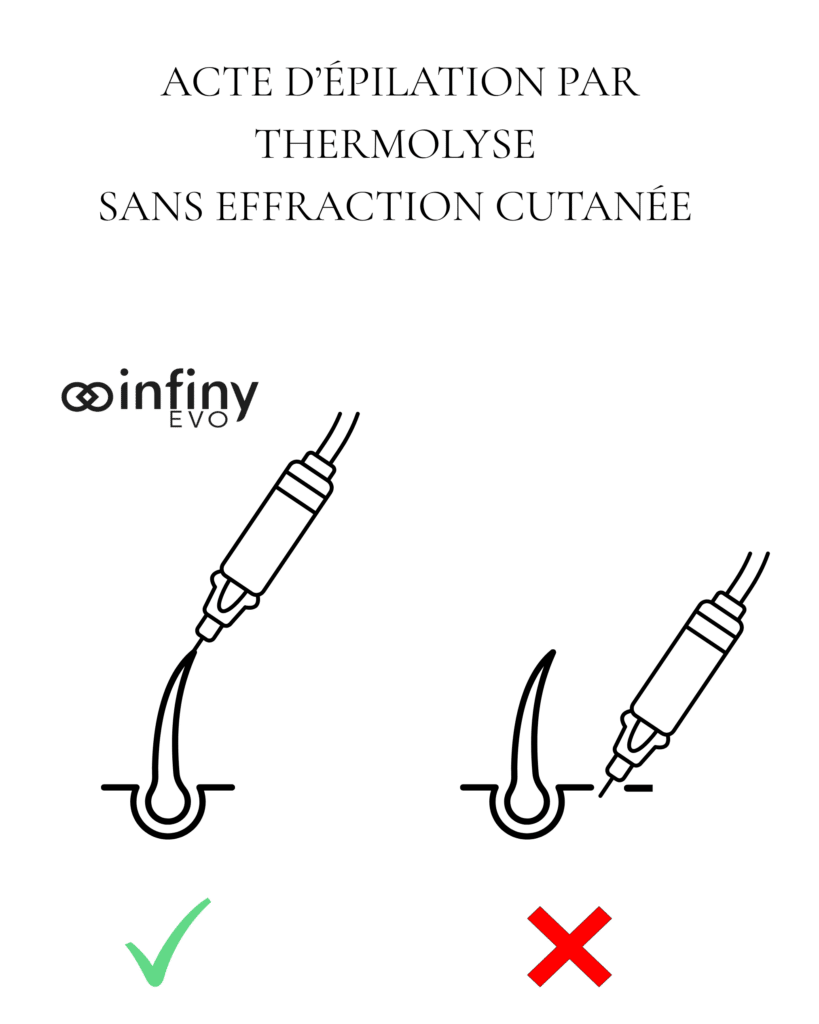 thermolyse vectorielle infiny evo article 2